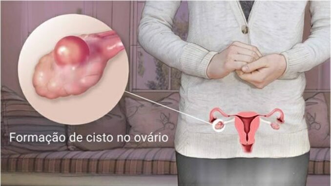 Sinais de Cisto no Ovário