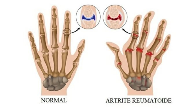 Sinais de artrite reumatoide