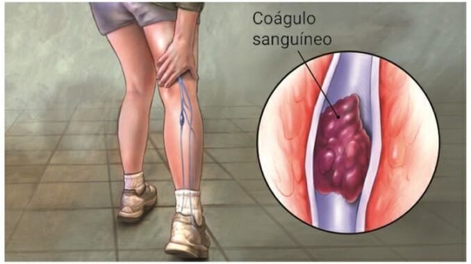 Sintomas de trombose