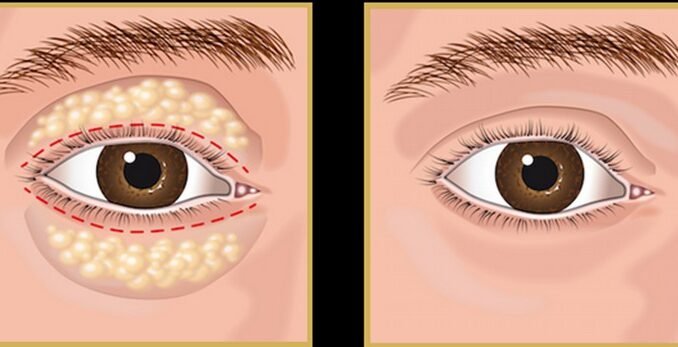 bolsas sob os olhos